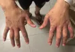 داء الجرب يجتاح سجون الاحتلال