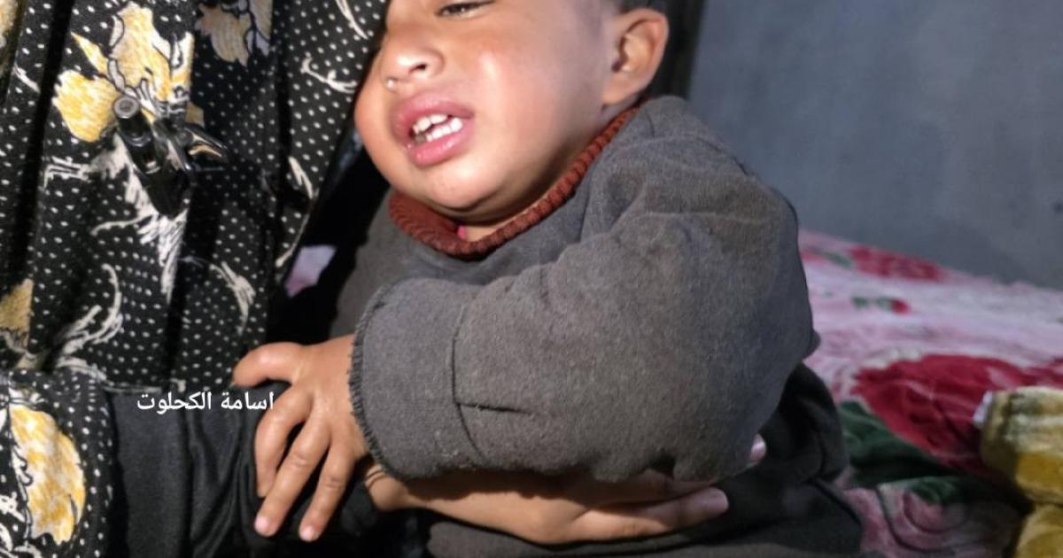 فلسطين – خاص: مهران الشهاب: تعذيب طفل عمره عام واحد في غزة قمة الانحطاط الأخلاقي ويتطلب رداً دولياً حاسماً