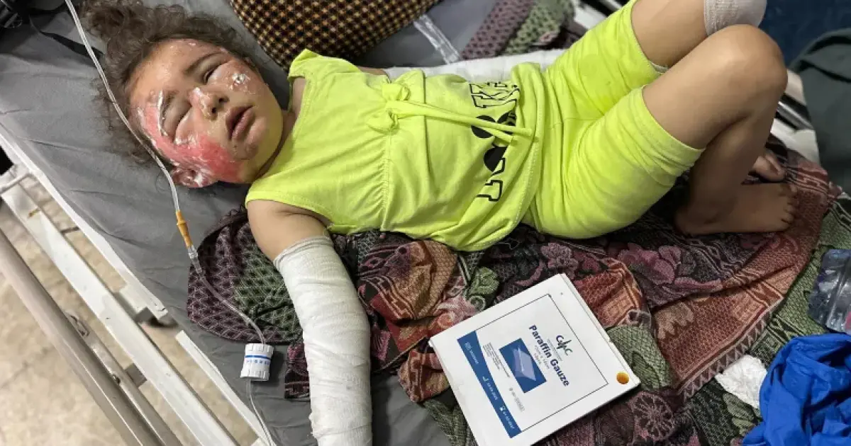 فلسطين – أفاد آلاف المدنيين في غزة أنهم يعانون من حروق خطيرة وسط نقص حاد في العلاج