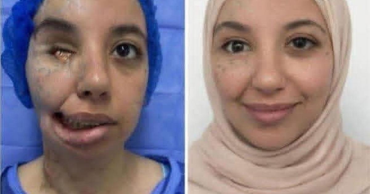 فلسطين – بالصور إنجاز طبي نادر لجراح مصري يعيد ملامح وجه فتاة من غزة