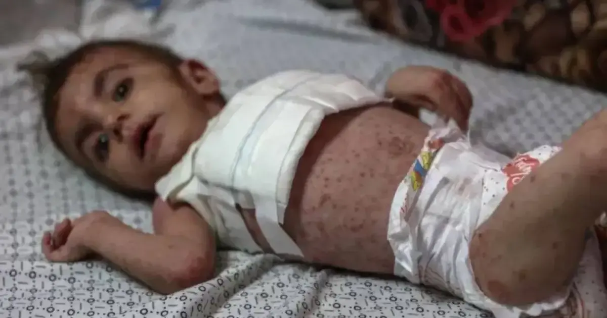 فلسطين – الأونروا تحذر من كارثة صحية في غزة: 125 ألف التهاب جلدي نتيجة انتشار القوارض