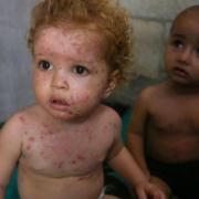 جدري الماء يزحف بين أطفال غزة