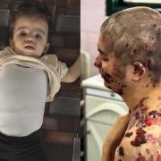 قلب "غزل" وجسد "عبد الله"..  ضحايا حصار الاحتلال لفرص الحياة في غزة