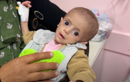 طفل يعاني من سوء التغذية في غزة إثر استمرار الحصار والعدوان "الإسرائيلي"