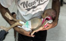 جثمان الطفلة زينب أبو حليب التي استشهدت بسبب سوء التغذية الحاد في غزة