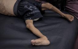 غزة تختنق بصمت.. متلازمة "غيلان باريه" النادرة تفتك بالمرضى وسط عجز طبي كامل