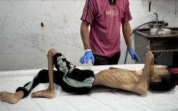 سوء التغذية في غزة