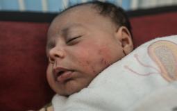 طفل تعرض لعضة من قبل "قارض" في خيمة نزوح عائلته بغزة