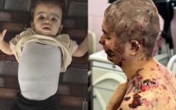 قلب "غزل" وجسد "عبد الله"..  ضحايا حصار الاحتلال لفرص الحياة في غزة