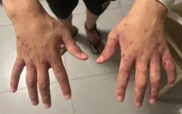 داء الجرب يجتاح سجون الاحتلال