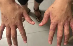 داء الجرب يجتاح سجون الاحتلال