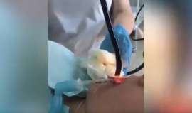 أطباء يستخرجون ثعبانا ضخما تسلل إلى فم امرأة