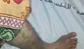 #شاهد أحد جرحى قطاع غزة.. يلقي قصيده لمسيرة العودة