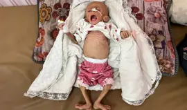 طفلة غزية تعاني من سوء تغذية حاد