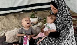 طفل غزي يعاني من سوء تغذية حاد