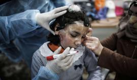 نساء غزة يترددن على مراكز التجميل في القاهرة.. لإزالة تشوهات الحرب!