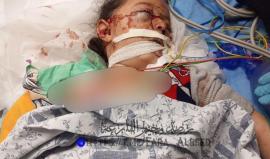الطفلة المصابة