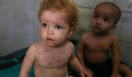 جدري الماء يزحف بين أطفال غزة