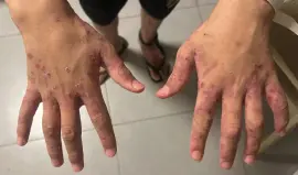 داء الجرب يجتاح سجون الاحتلال