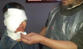 ريف دمشق- مناشدة لإخراج الطفل أيهم برهان الذي أصيب بالعين نتيجة القصف على بلدة مضايا المحاصرة من قبل النظام وميليشياته