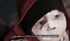 وجه جديدة من معاناة #الغوطة_الشرقية ..
الطفل قاسم من حي جوبر الدمشقي .. تعرض لقصف مع عائلته حرمه من التكلم والأكل وفقدان أطراف من وجهه البريء
