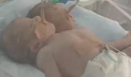 #شاهد ولادة توأم سيامي بجسد واحد ورأسين بـ غزة في حالة نادرة جدا