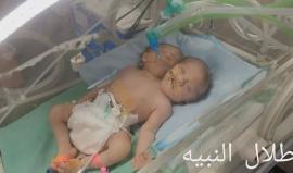 ولادة توأم برأسين وجسد واحد بمستشفى الشفاء بغزة
تصوير طلال النبيه