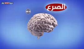 هل أصبح التحكم بـأكثر الأمراض غموضًا "الصرع" ممكن؟