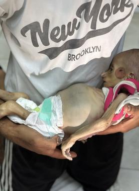 جثمان الطفلة زينب أبو حليب التي استشهدت بسبب سوء التغذية الحاد في غزة