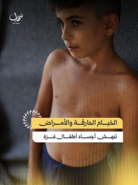 الخيام الحارقة والأمراض تنهش أجساد أطفال غزة