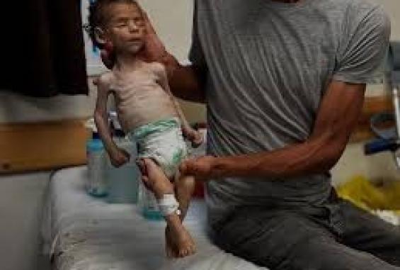 المجاعة تنتشر في قطاع غزة