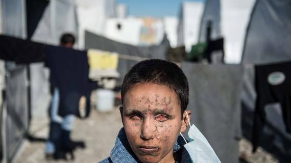 "يزن صبحي" طفل سوري فقد بصره خلال قصف قوات النظام السوري على مدينة حلب