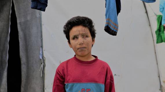 يزن صبحي، طفل سوري فقد عينيه بانفجار لغم أرضي من مخلفات الحرب في منبج بريف حلب