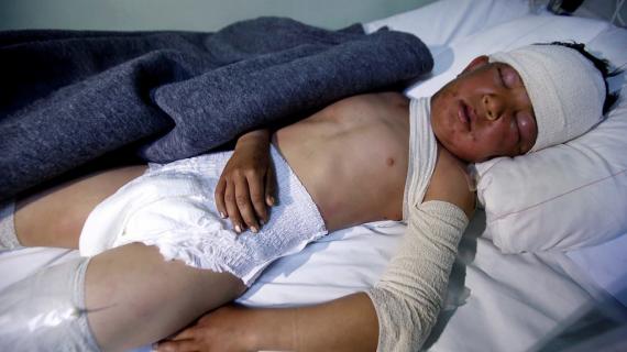 مشاهد لضحايا قصف بالأسلحة الكيميائية على مدينة الموصل