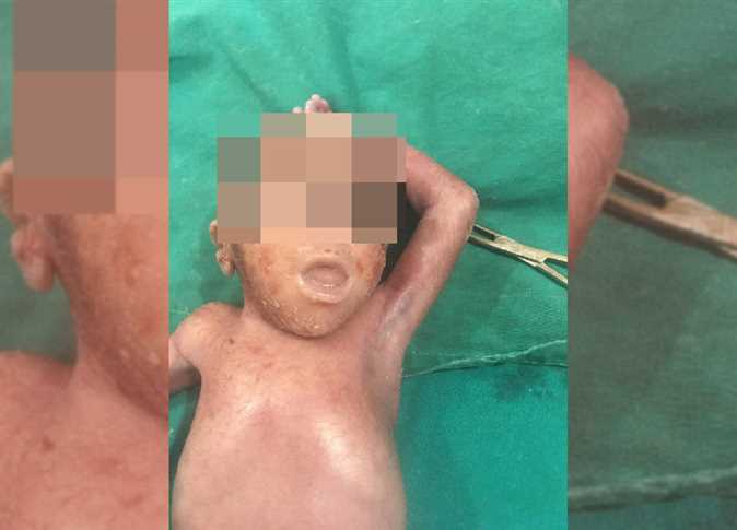ولادة نادرة لسيدة وضعت مولودها مصاب بعيوب خلقية وعين واحدة 